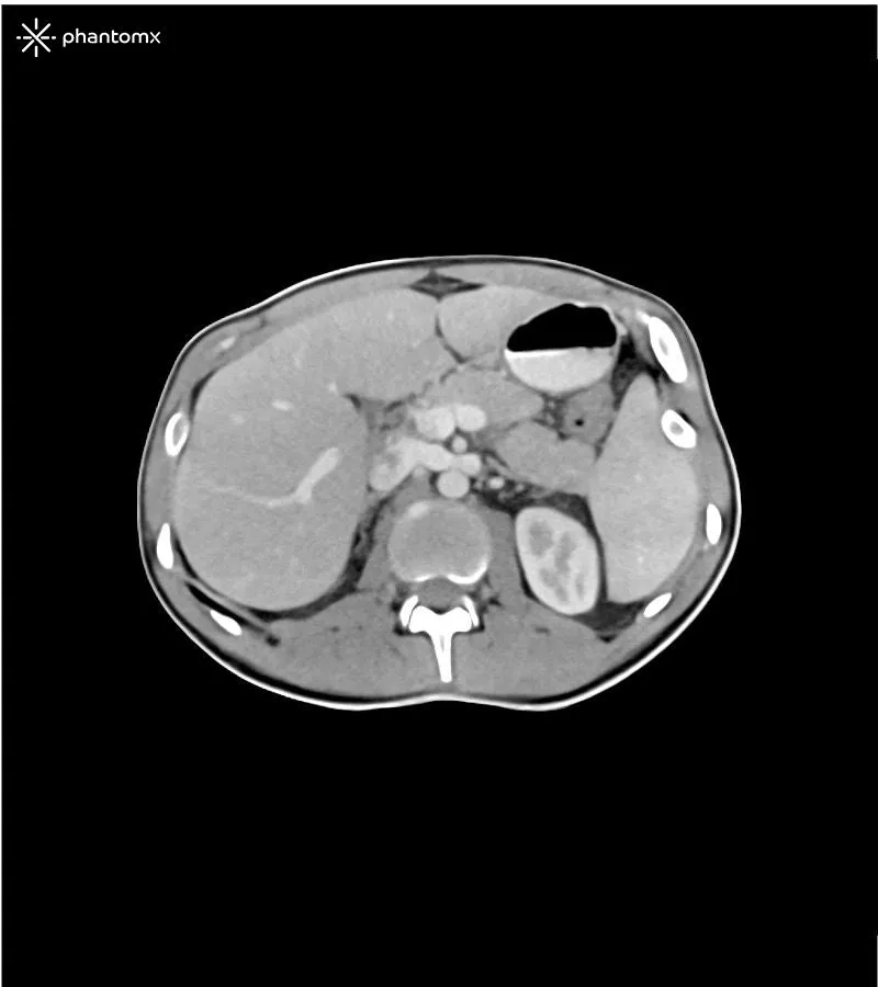 Abdomen and Pelvis Phantom - Portal Venous Phase