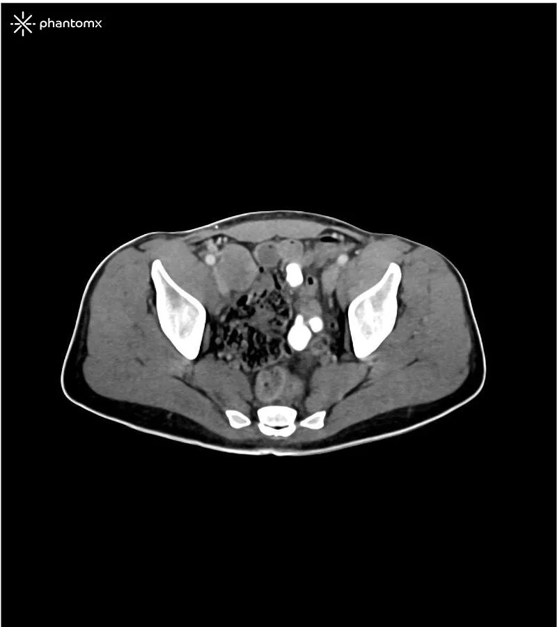 Abdomen and Pelvis Phantom - Portal Venous Phase