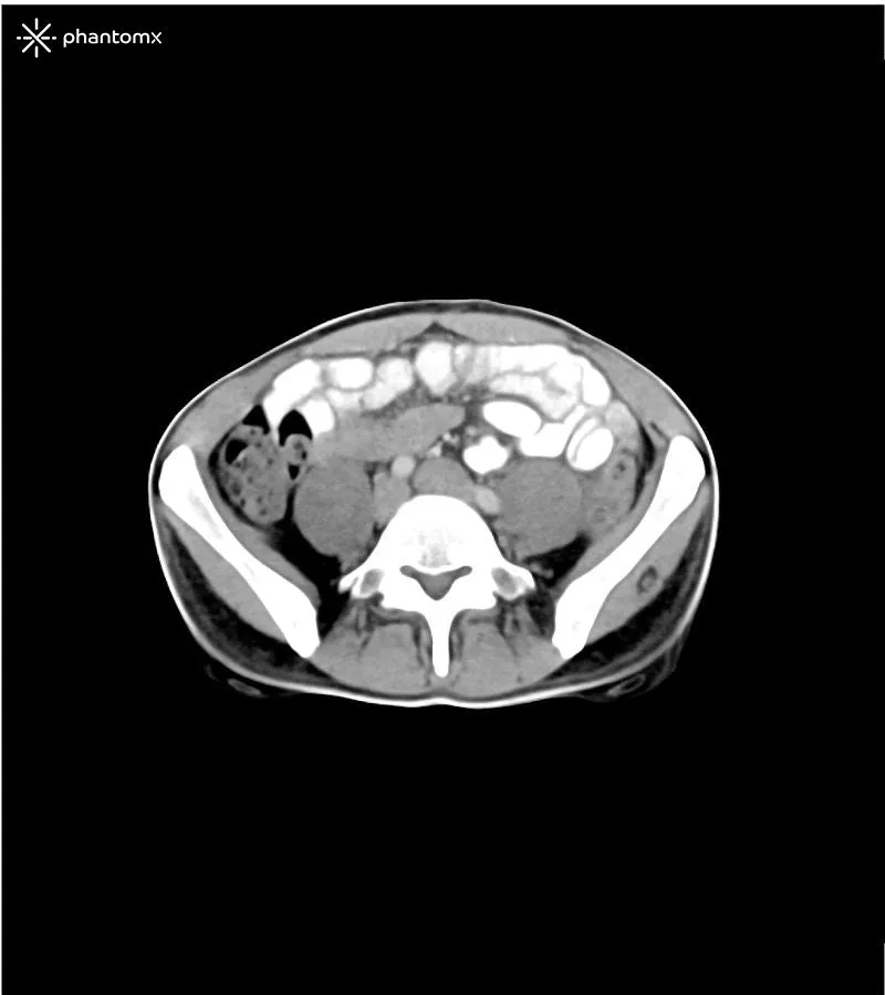 Abdomen and Pelvis Phantom - Portal Venous Phase