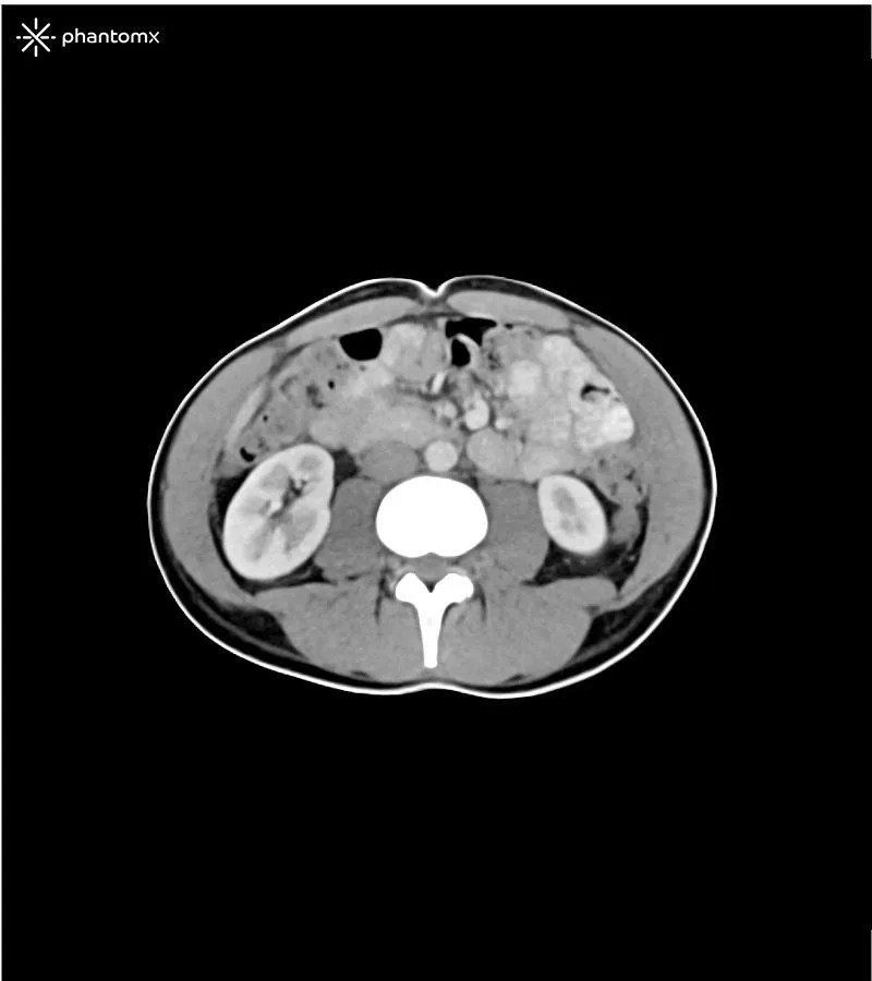 Abdomen and Pelvis Phantom - Portal Venous Phase