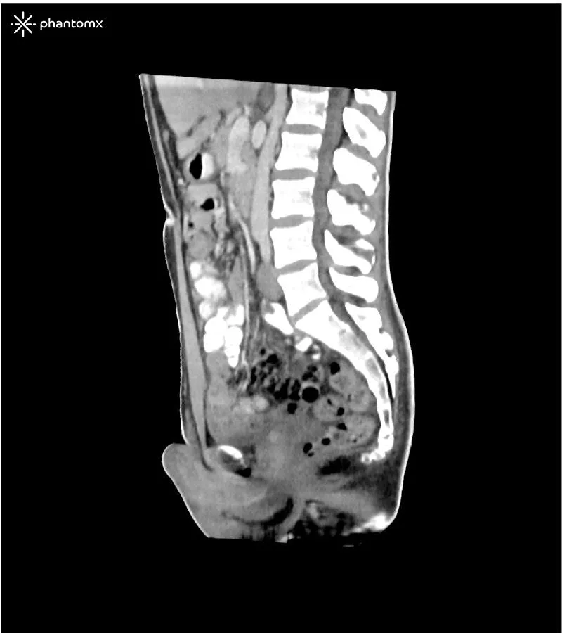 Abdomen and Pelvis Phantom - Portal Venous Phase