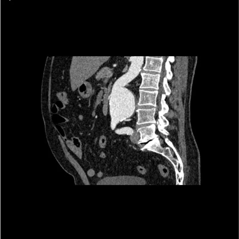 Abdomen Phantom - Aortic Aneurysm