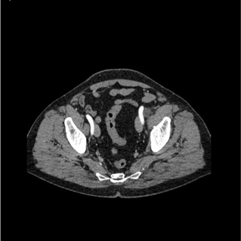 Abdomen Phantom - Aortic Aneurysm