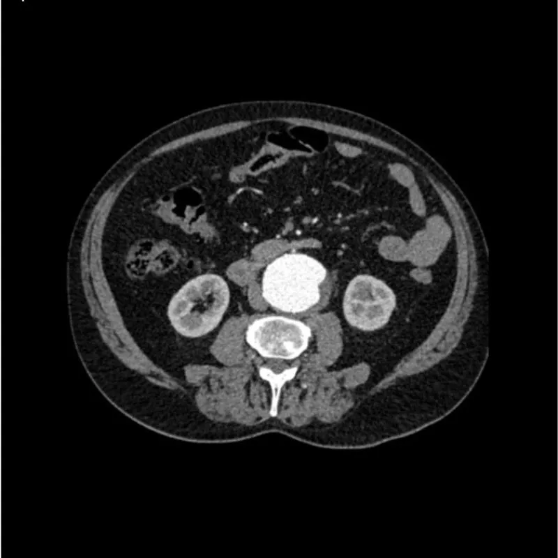 Abdomen Phantom - Aortic Aneurysm