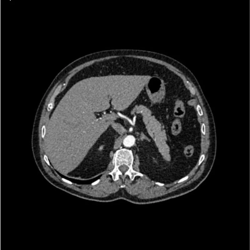 Abdomen Phantom - Aortic Aneurysm