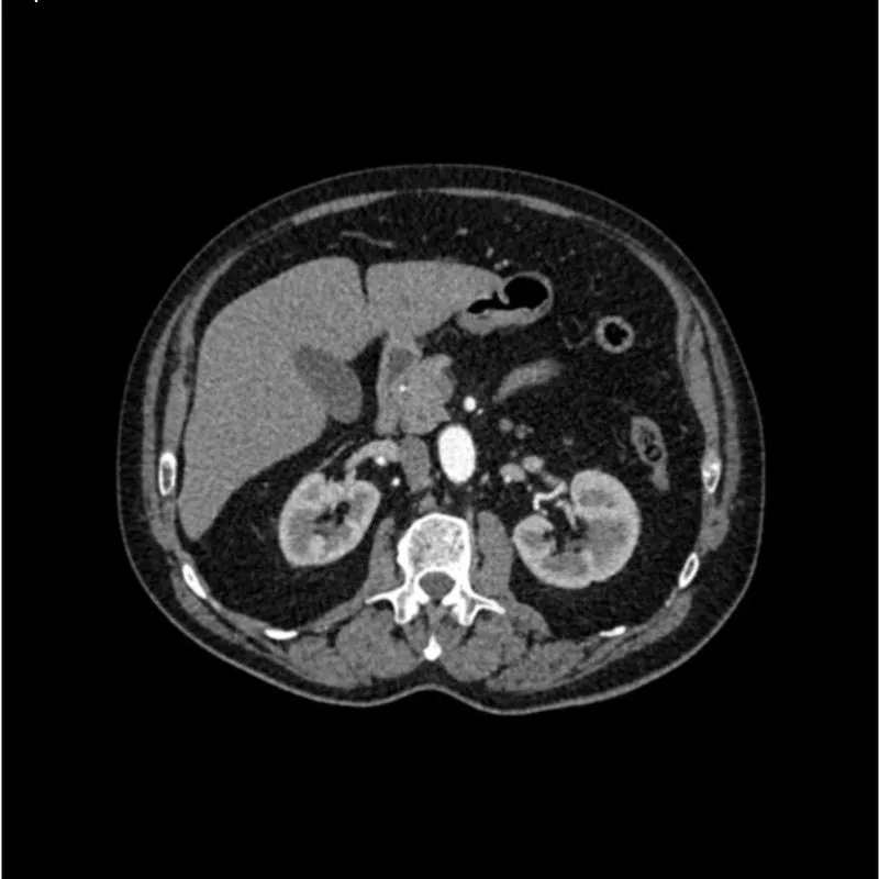 Abdomen Phantom - Aortic Aneurysm