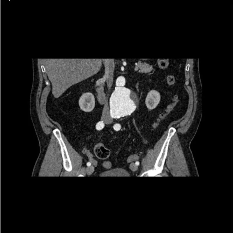 Abdomen Phantom - Aortic Aneurysm