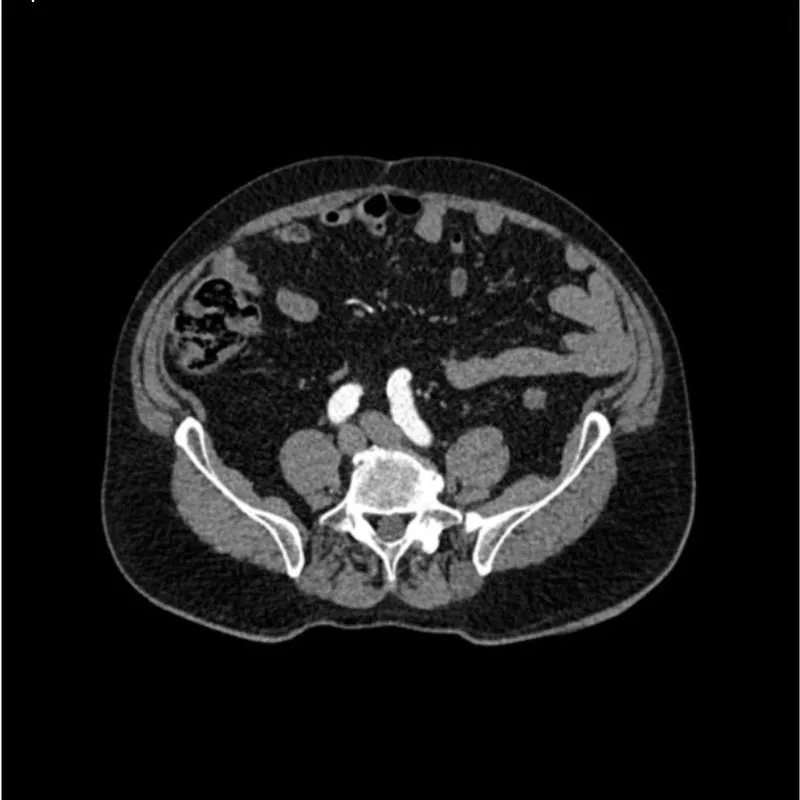 Abdomen Phantom - Aortic Aneurysm