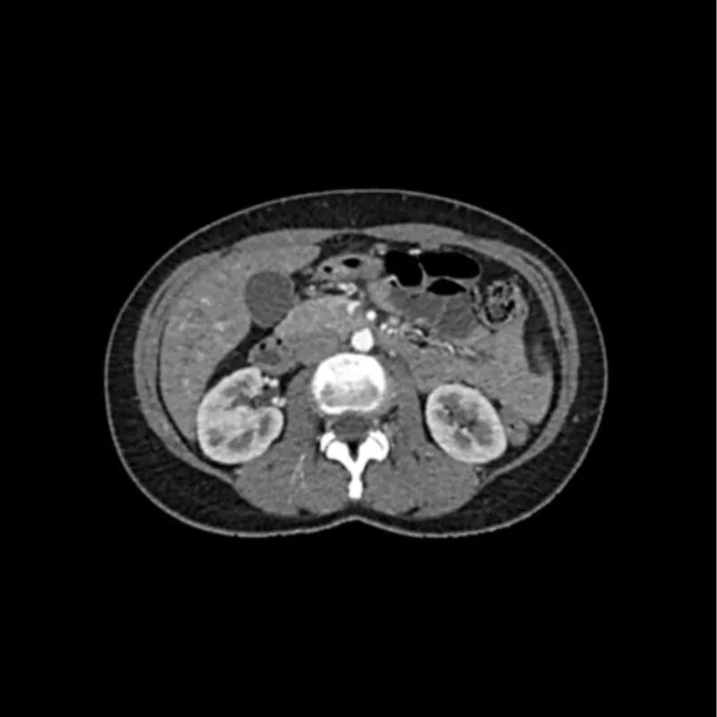 Abdomen Phantom - Arterial Phase