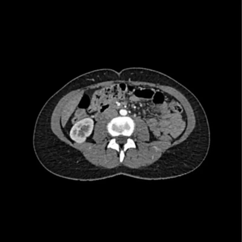 Abdomen Phantom - Arterial Phase