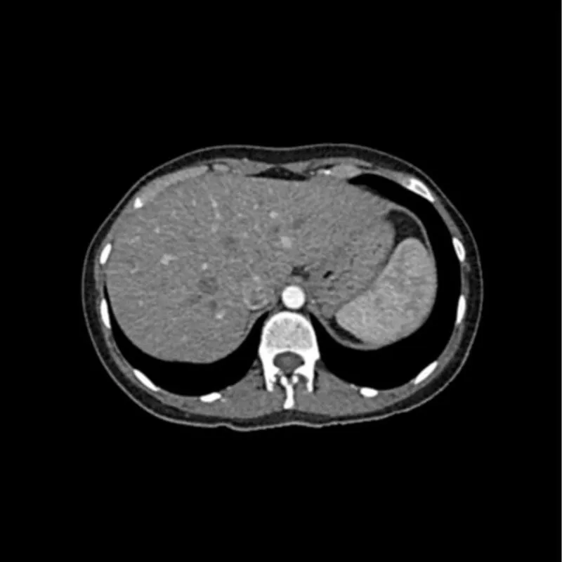 Abdomen Phantom - Arterial Phase