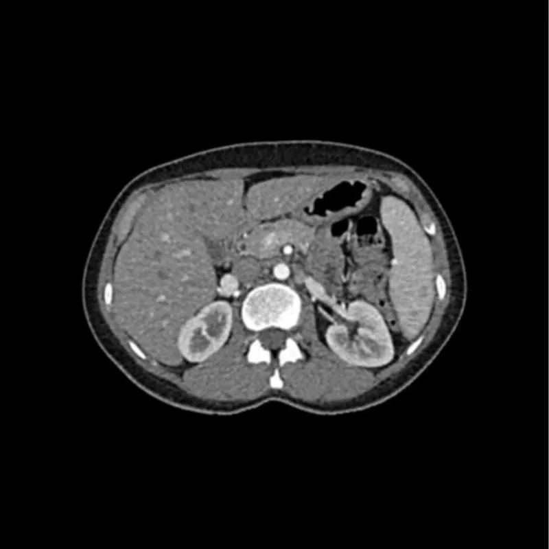 Abdomen Phantom - Arterial Phase