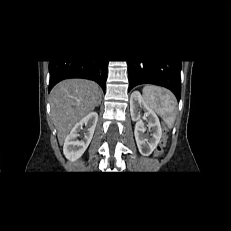 Abdomen Phantom - Arterial Phase