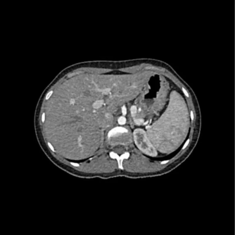 Abdomen Phantom - Arterial Phase