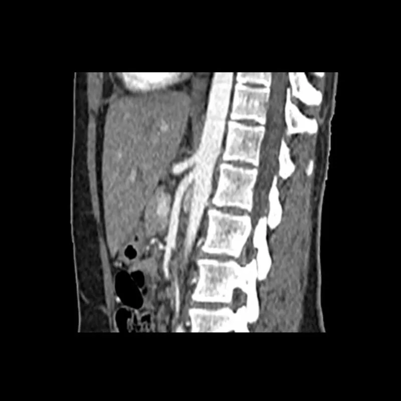 Abdomen Phantom - Arterial Phase