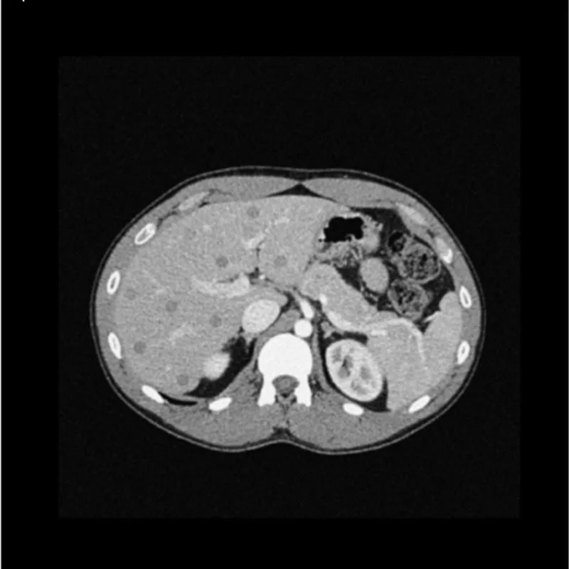 Abdomen Phantom - Low-Contrast Spheres