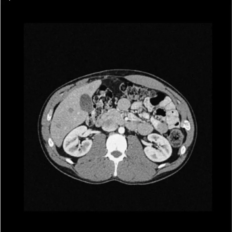 Abdomen Phantom - Low-Contrast Spheres