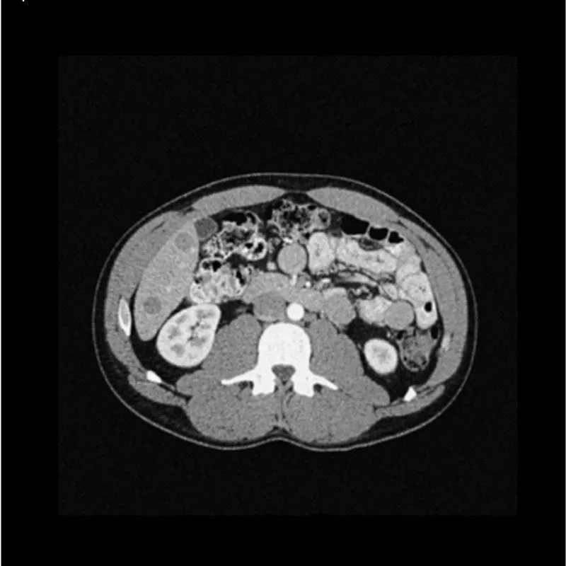 Abdomen Phantom - Low-Contrast Spheres