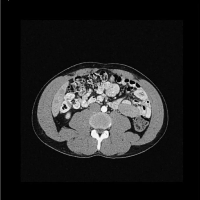 Abdomen Phantom - Low-Contrast Spheres