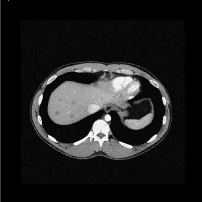 Abdomen Phantom - Low-Contrast Spheres