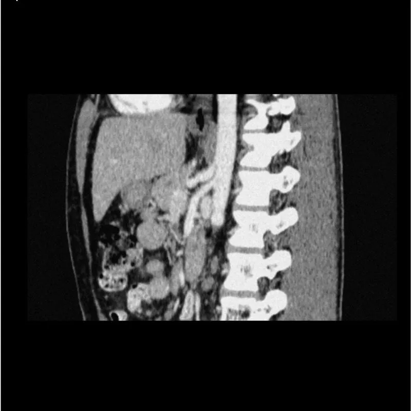 Abdomen Phantom - Low-Contrast Spheres