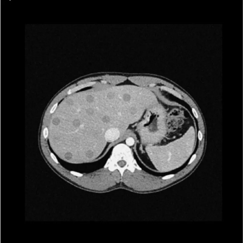 Abdomen Phantom - Low-Contrast Spheres