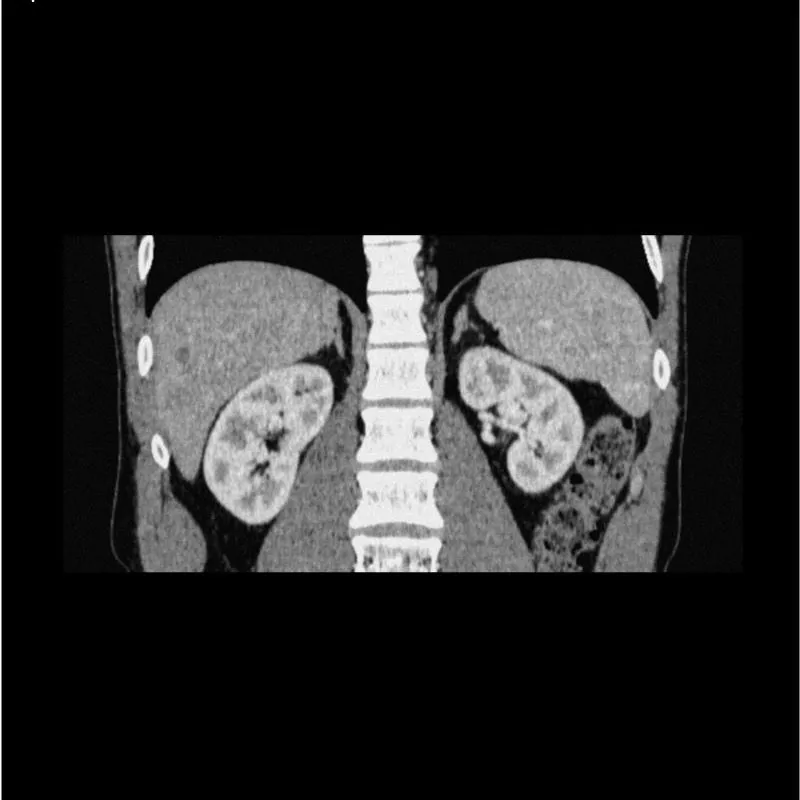 Abdomen Phantom - Low-Contrast Spheres