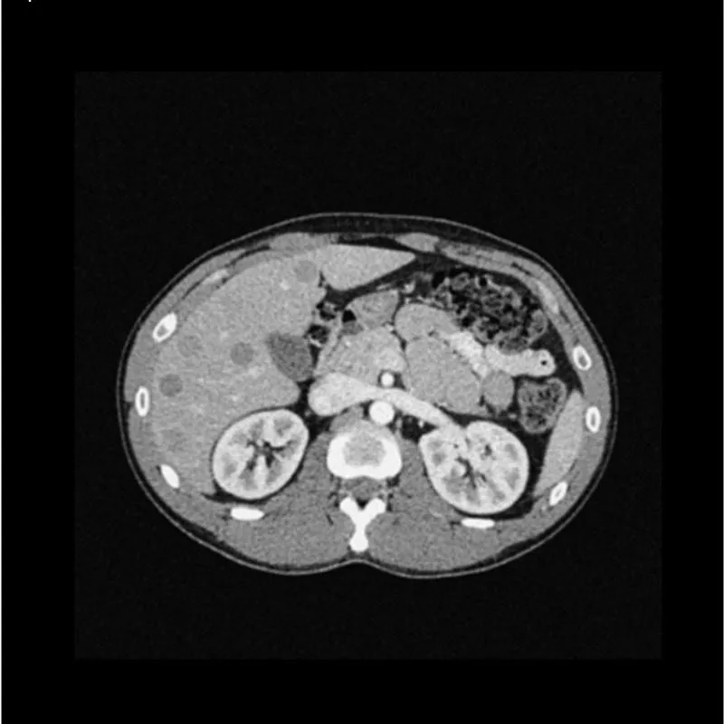 Abdomen Phantom - Low-Contrast Spheres