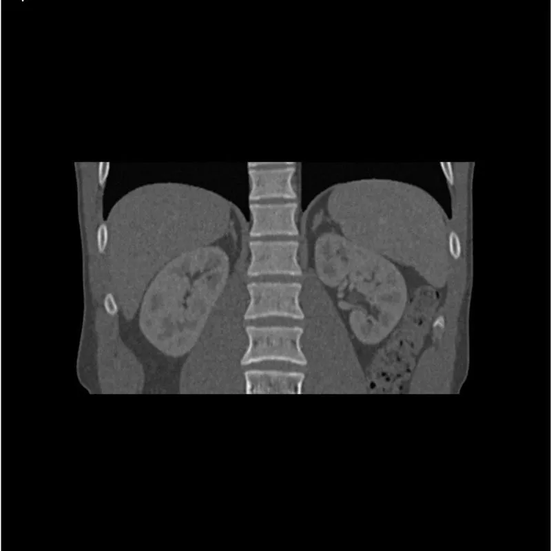 Abdomen Phantom - Portal Venous Phase