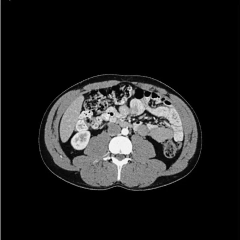 Abdomen Phantom - Portal Venous Phase