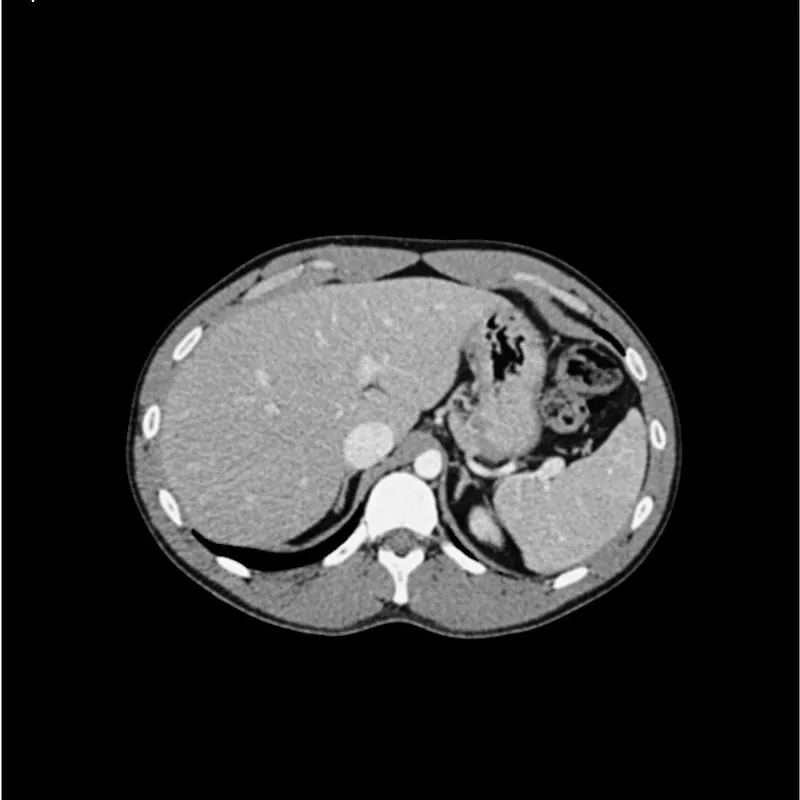 Abdomen Phantom - Portal Venous Phase