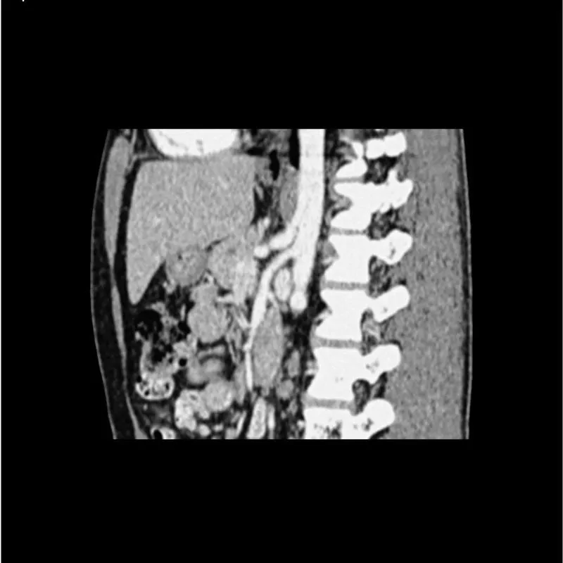 Abdomen Phantom - Portal Venous Phase