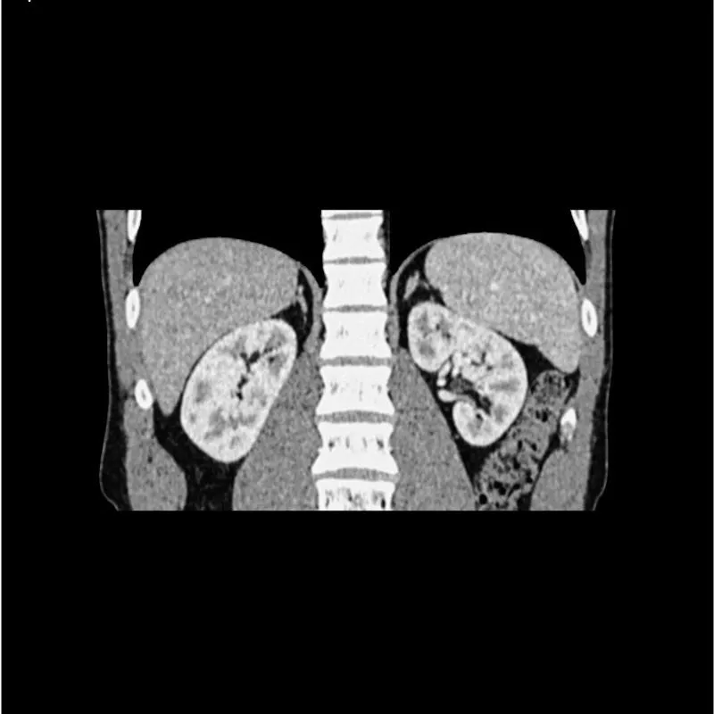 Abdomen Phantom - Portal Venous Phase