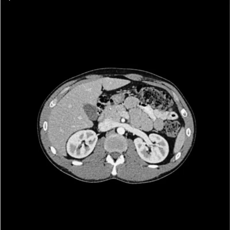 Abdomen Phantom - Portal Venous Phase