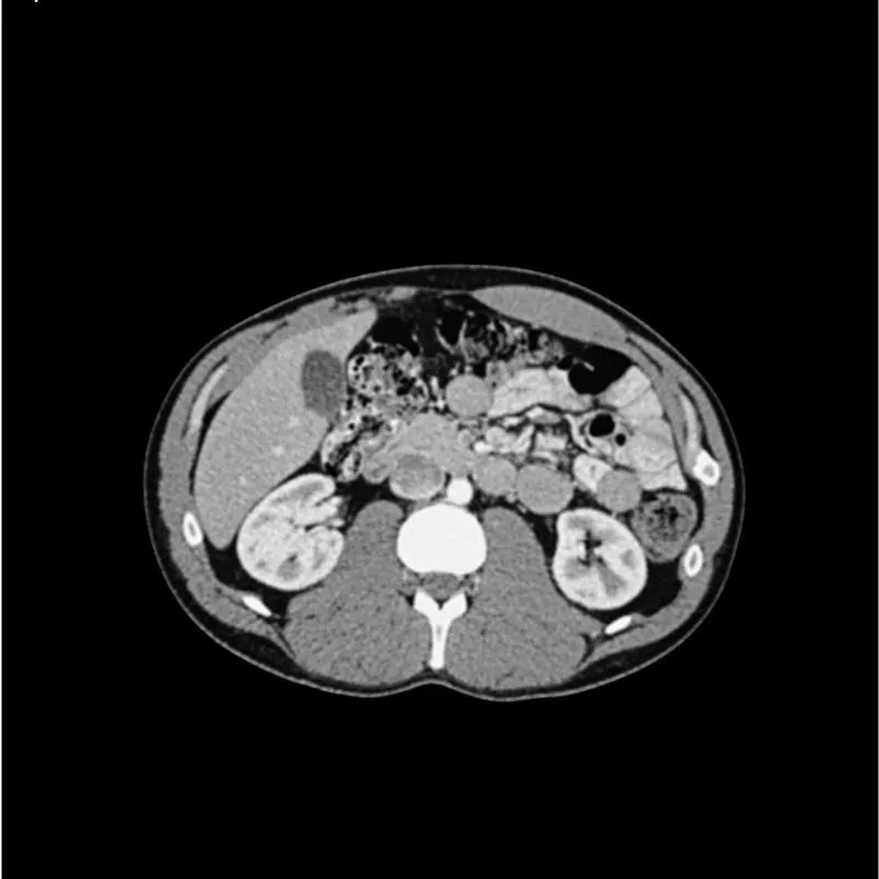 Abdomen Phantom - Portal Venous Phase