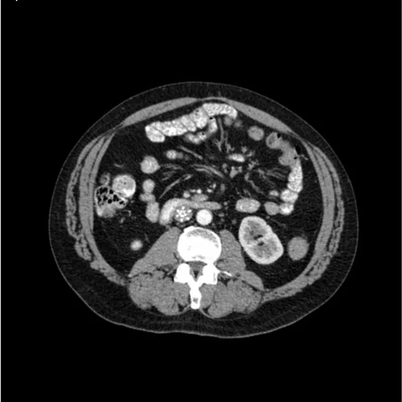 Abdomen Phantom - PV Cirrhosis