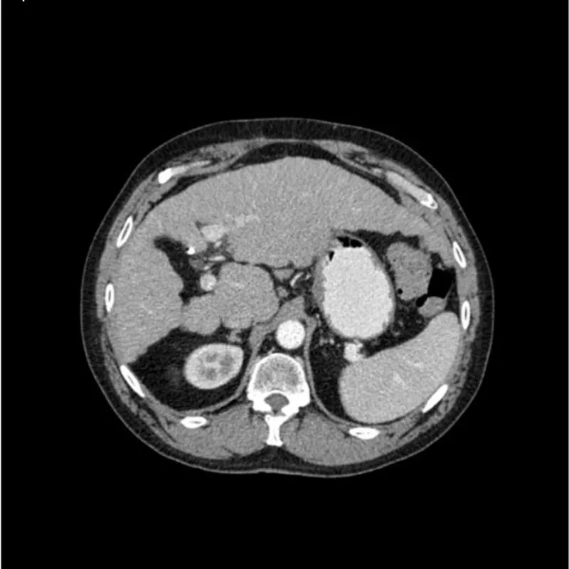 Abdomen Phantom - PV Cirrhosis