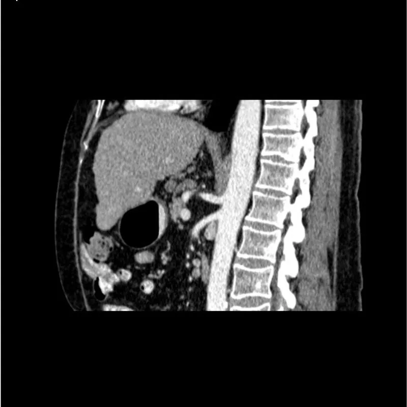 Abdomen Phantom - PV Cirrhosis