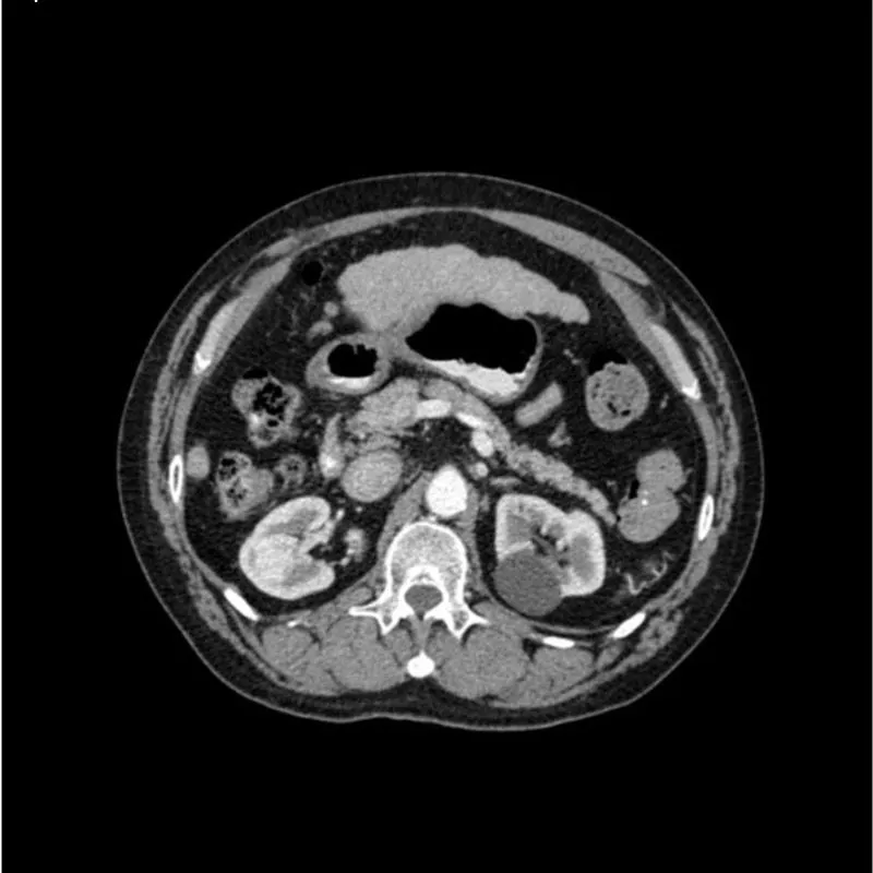 Abdomen Phantom - PV Cirrhosis