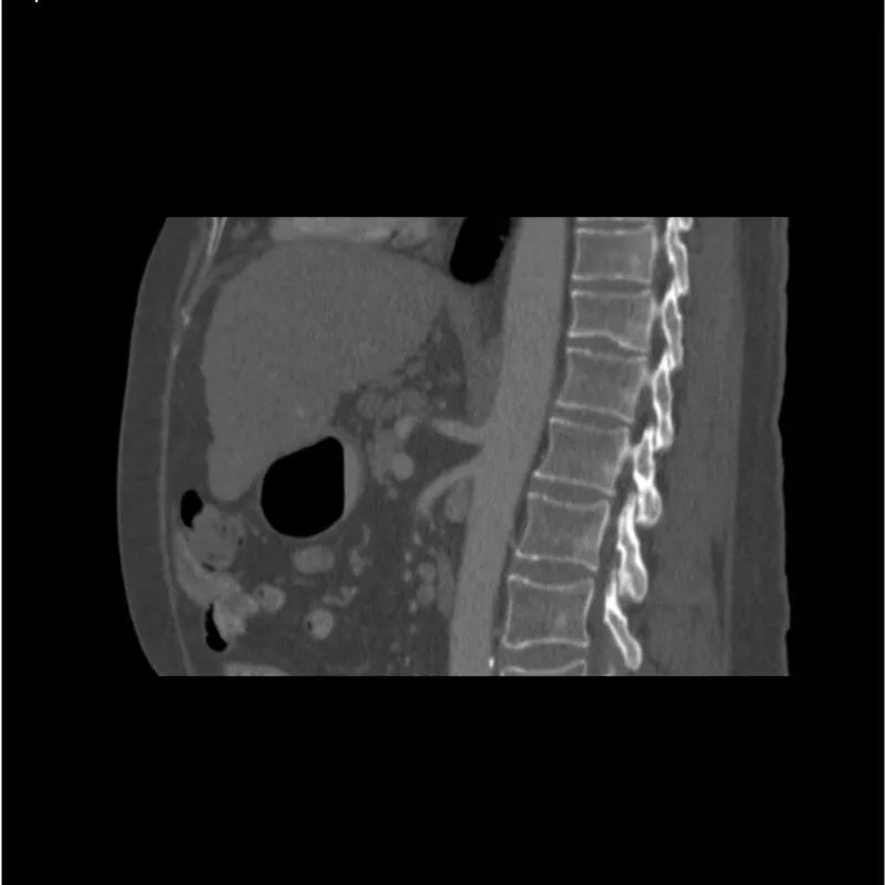 Abdomen Phantom - PV Cirrhosis