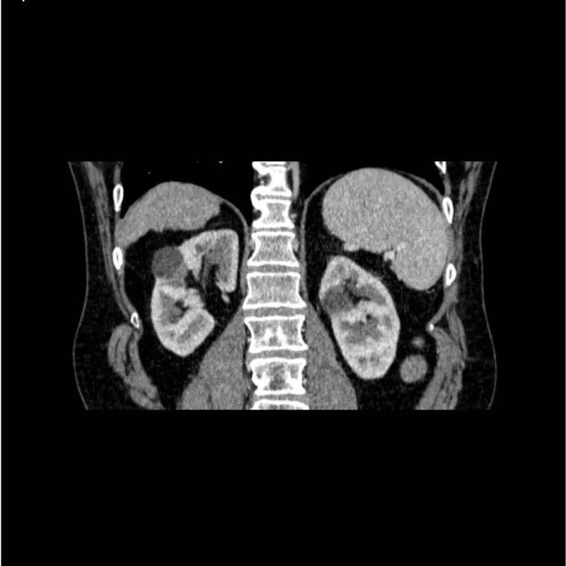 Abdomen Phantom - PV Cirrhosis