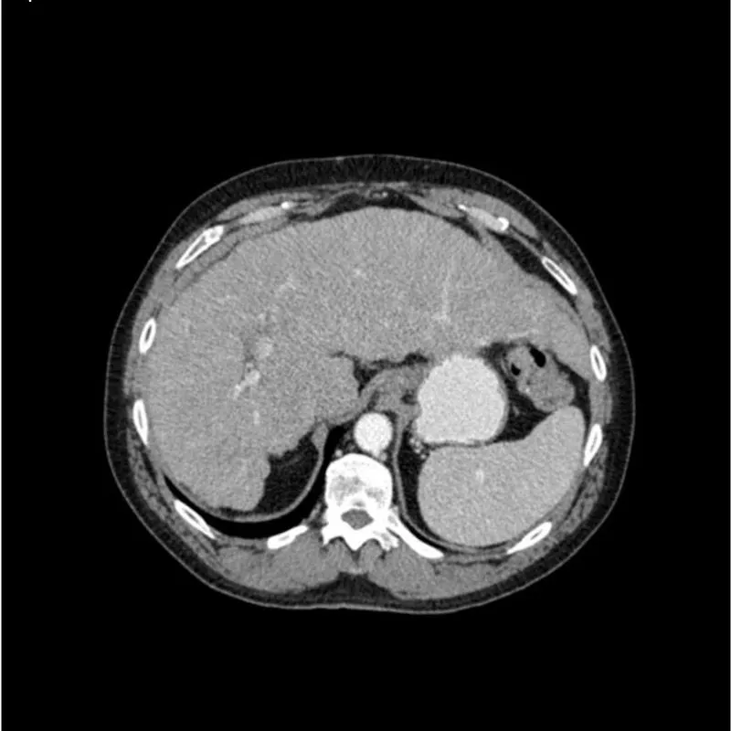 Abdomen Phantom - PV Cirrhosis