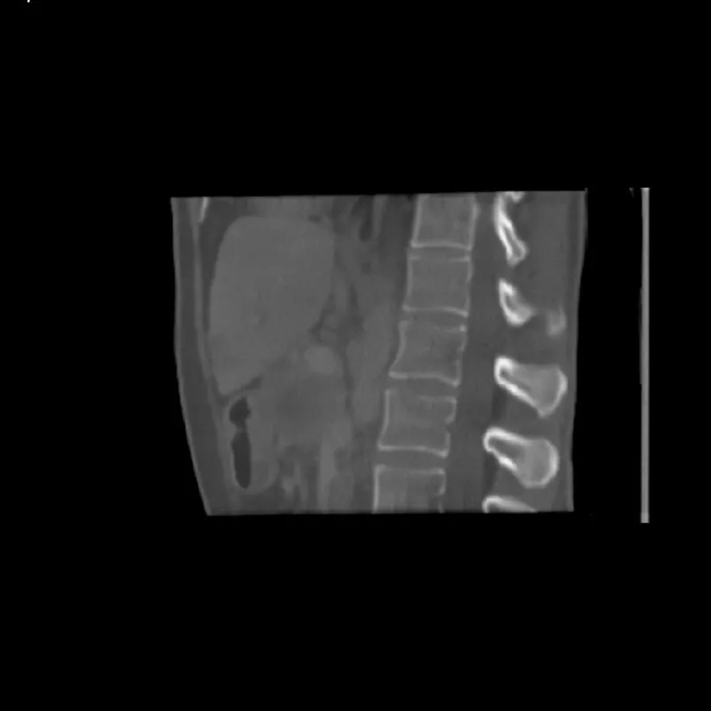 Abdomen Phantom - PV Liver Metastases