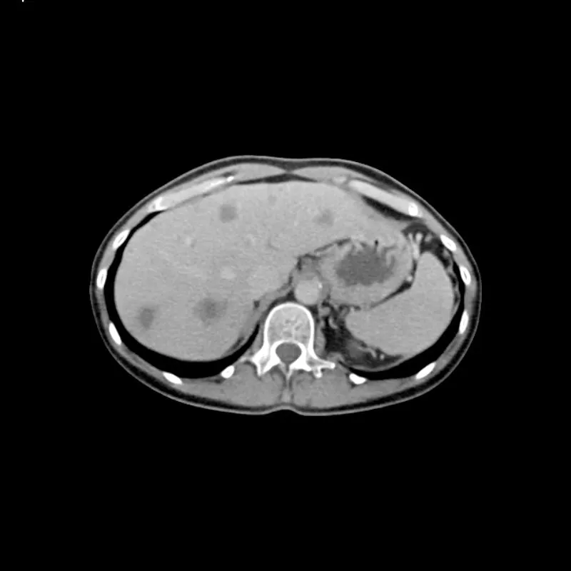 Abdomen Phantom - PV Liver Metastases