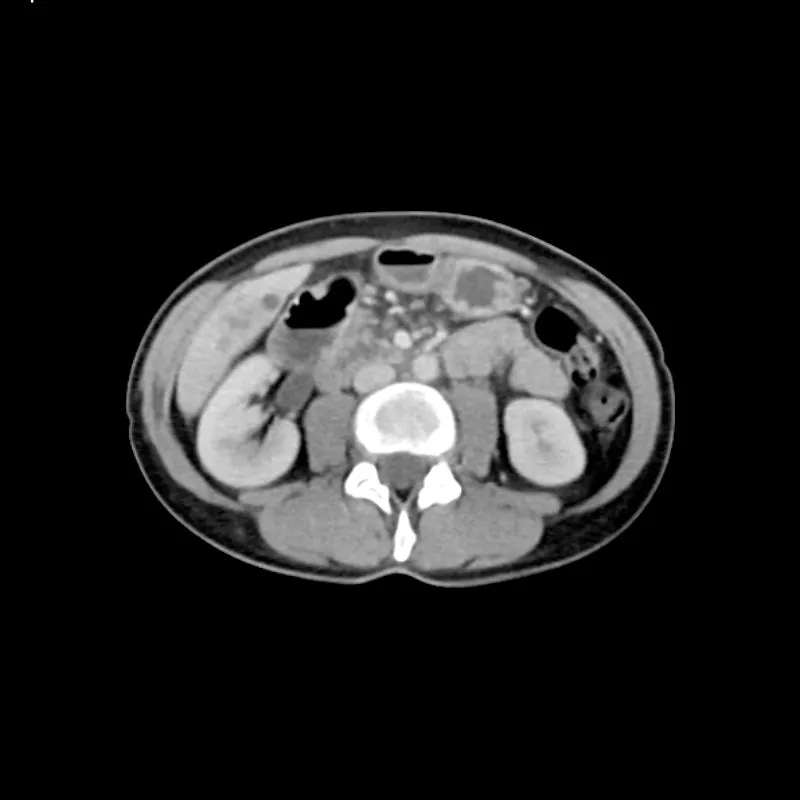 Abdomen Phantom - PV Liver Metastases