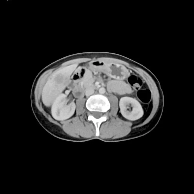 Abdomen Phantom - PV Liver Metastases