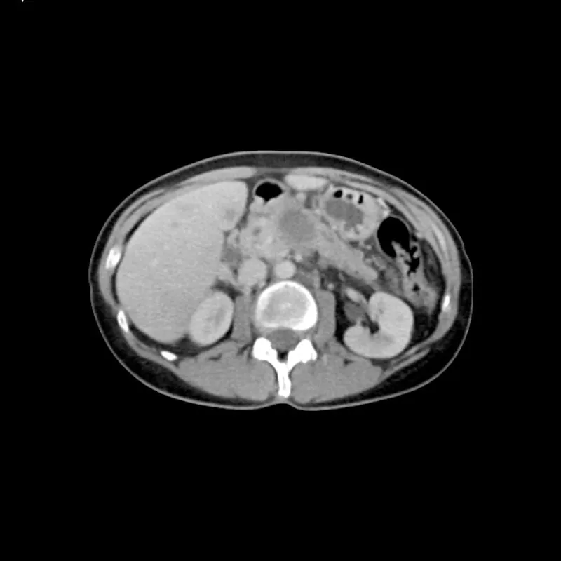 Abdomen Phantom - PV Liver Metastases