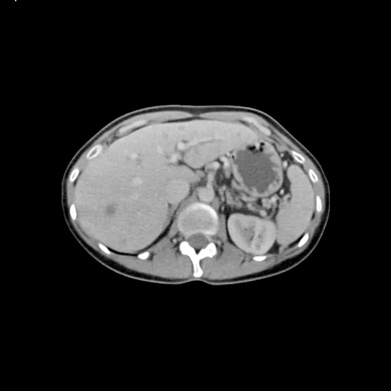 Abdomen Phantom - PV Liver Metastases