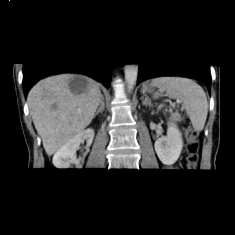 Abdomen Phantom - PV Liver Metastases