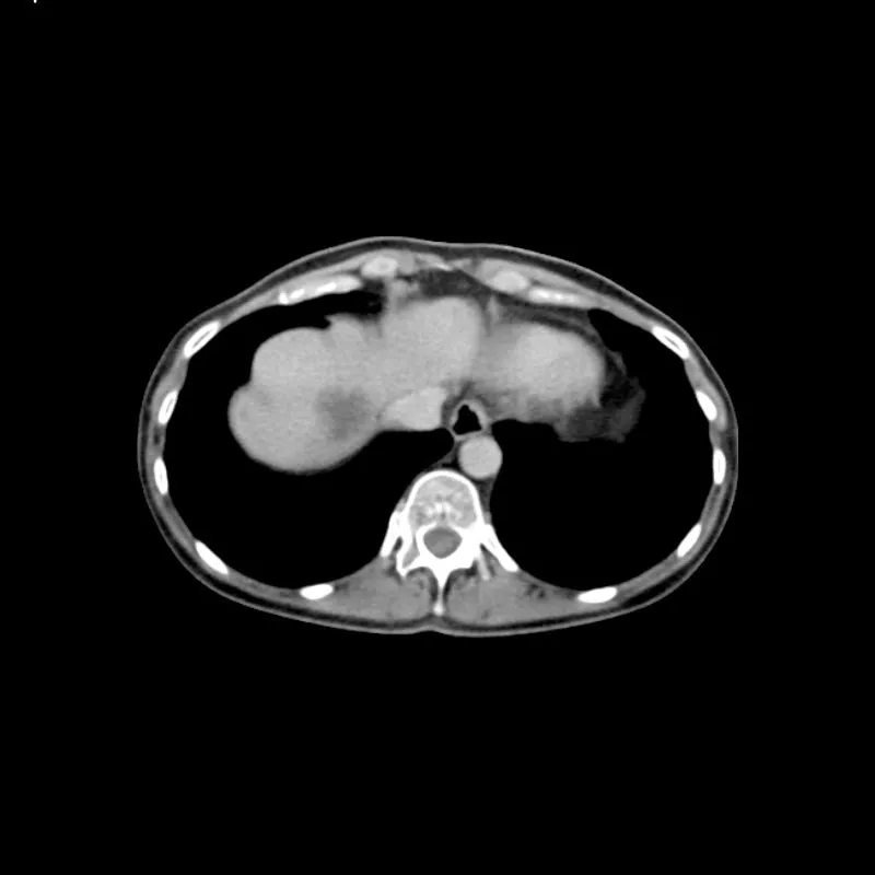 Abdomen Phantom - PV Liver Metastases